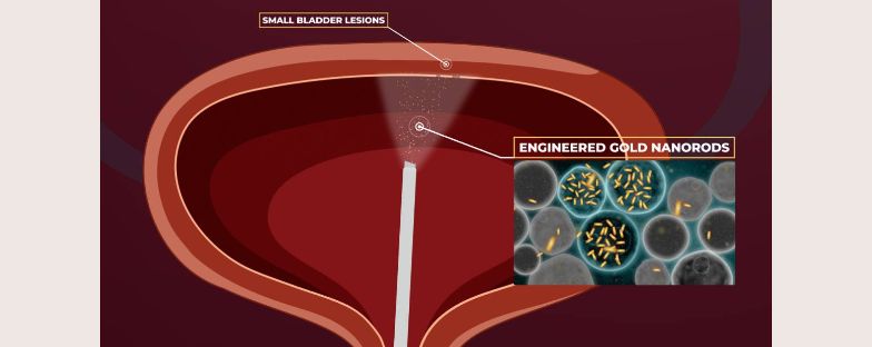 Nanoparticelle d’oro: dalla ricerca del San Raffaele la nuova frontiera per individuare ed eliminare i tumori alla vescica fino ad ora invisibili