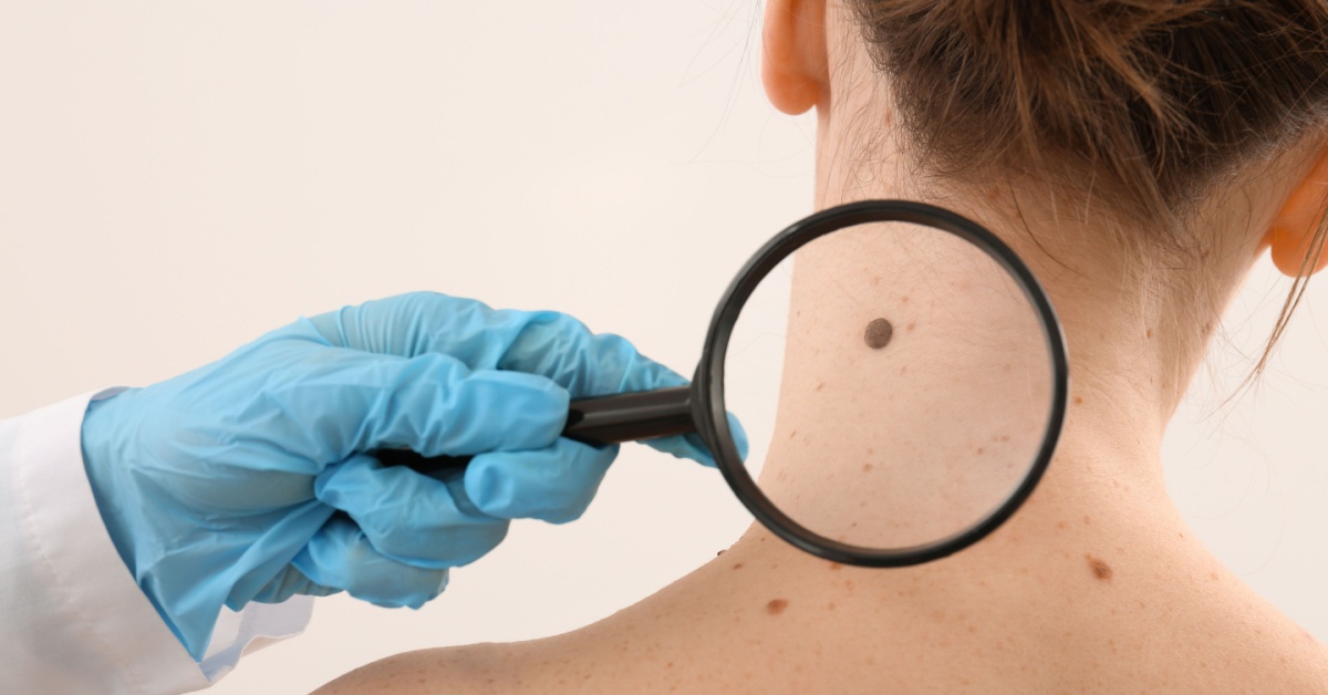 La ricerca sul melanoma, tra immunoterapia e nuove prospettive