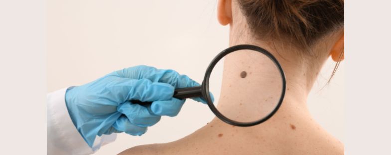 La ricerca sul melanoma, tra immunoterapia e nuove prospettive