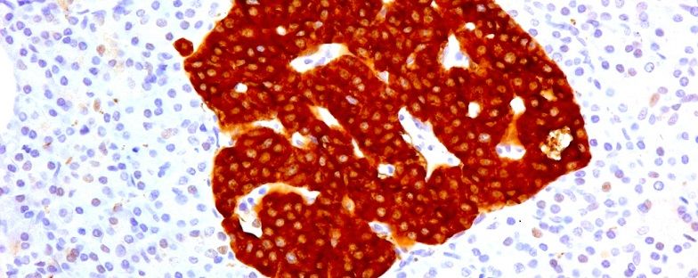 Diabete di tipo 1: presente e futuro del trapianto di isole